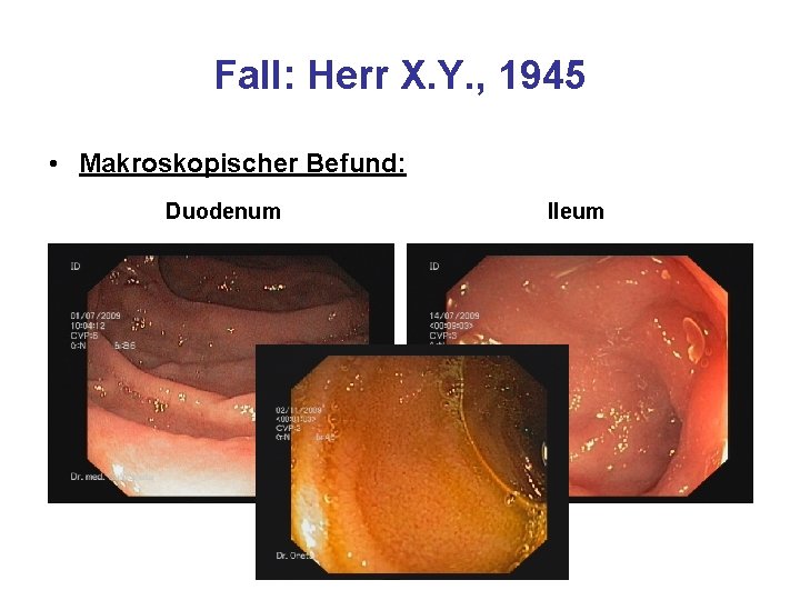 Fall: Herr X. Y. , 1945 • Makroskopischer Befund: Duodenum Ileum 