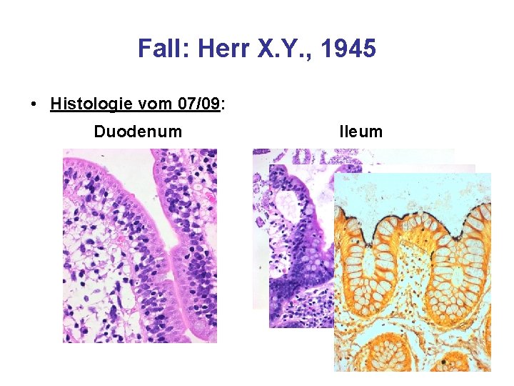 Fall: Herr X. Y. , 1945 • Histologie vom 07/09: Duodenum Ileum 