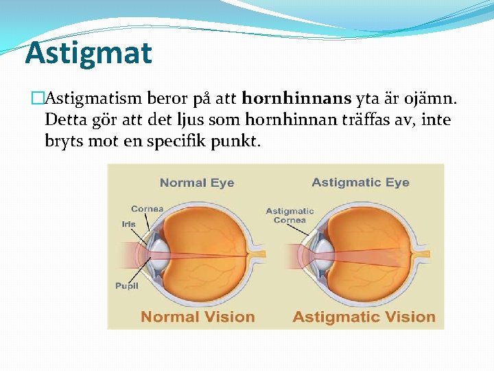 Astigmat �Astigmatism beror på att hornhinnans yta är ojämn. Detta gör att det ljus