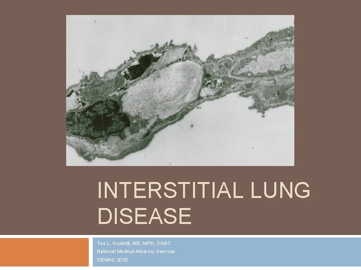 INTERSTITIAL LUNG DISEASE Tee L. Guidotti, MD, MPH, DABT National Medical Advisory Services OEMAC