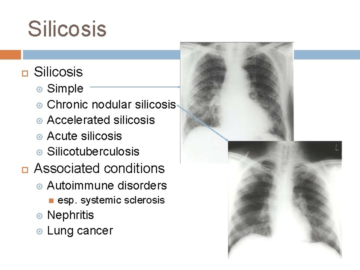 Silicosis Simple Chronic nodular silicosis Accelerated silicosis Acute silicosis Silicotuberculosis Associated conditions Autoimmune disorders