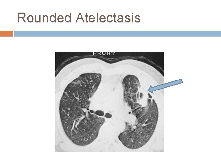 Rounded Atelectasis 