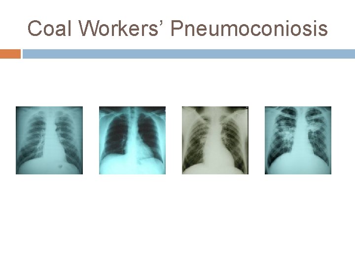 Coal Workers’ Pneumoconiosis 