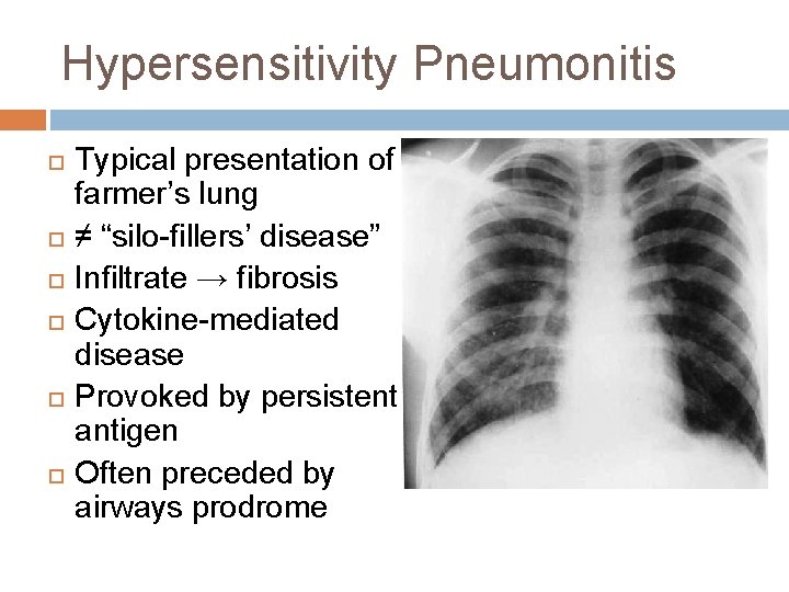 Hypersensitivity Pneumonitis Typical presentation of farmer’s lung ≠ “silo-fillers’ disease” Infiltrate → fibrosis Cytokine-mediated