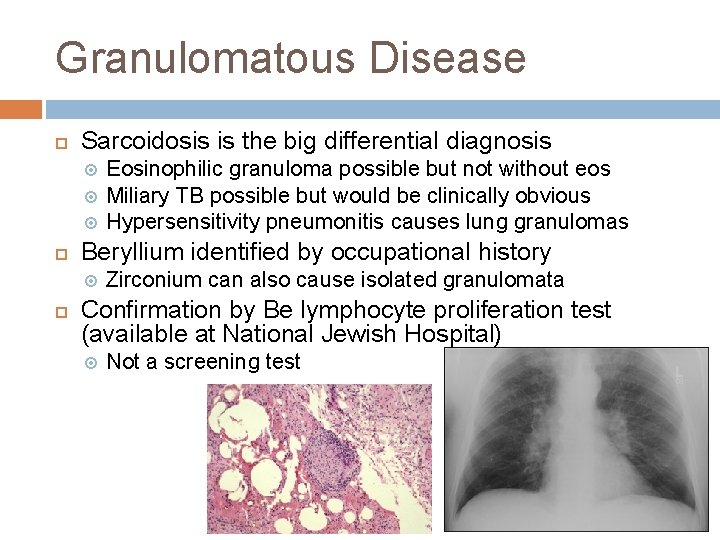 Granulomatous Disease Sarcoidosis is the big differential diagnosis Beryllium identified by occupational history Eosinophilic