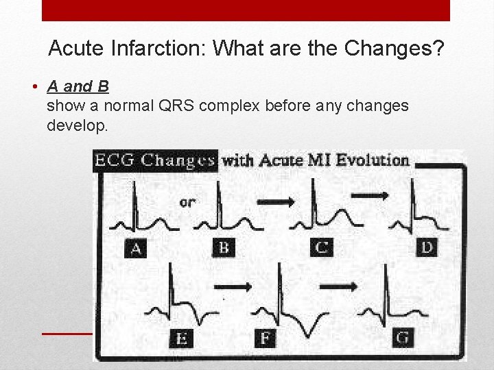 Acute Infarction: What are the Changes? • A and B show a normal QRS