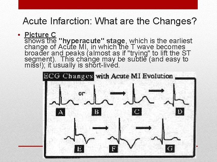 Acute Infarction: What are the Changes? • Picture C shows the "hyperacute" stage, which