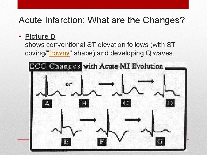 Acute Infarction: What are the Changes? • Picture D shows conventional ST elevation follows