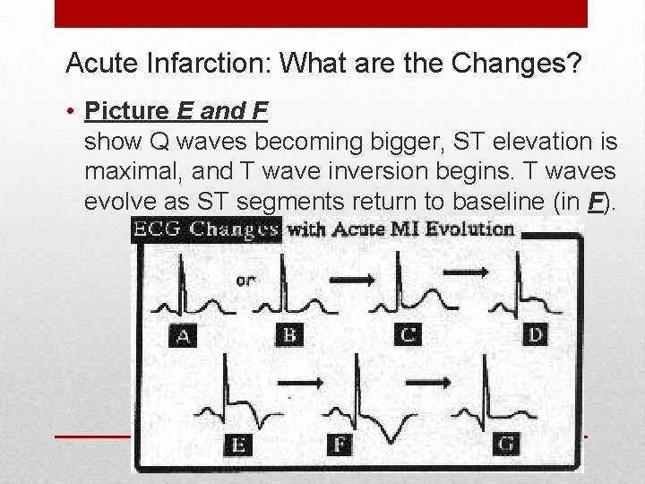 Acute Infarction: What are the Changes? • Picture E and F show Q waves