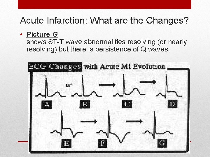 Acute Infarction: What are the Changes? • Picture G shows ST-T wave abnormalities resolving