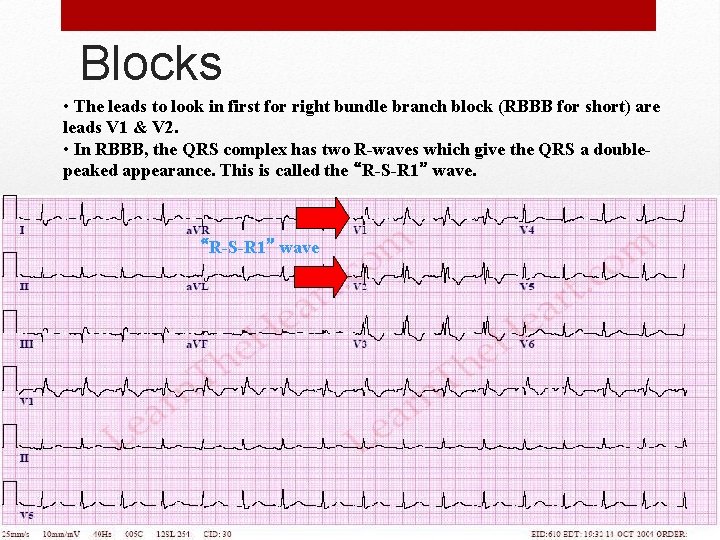 Blocks • The leads to look in first for right bundle branch block (RBBB