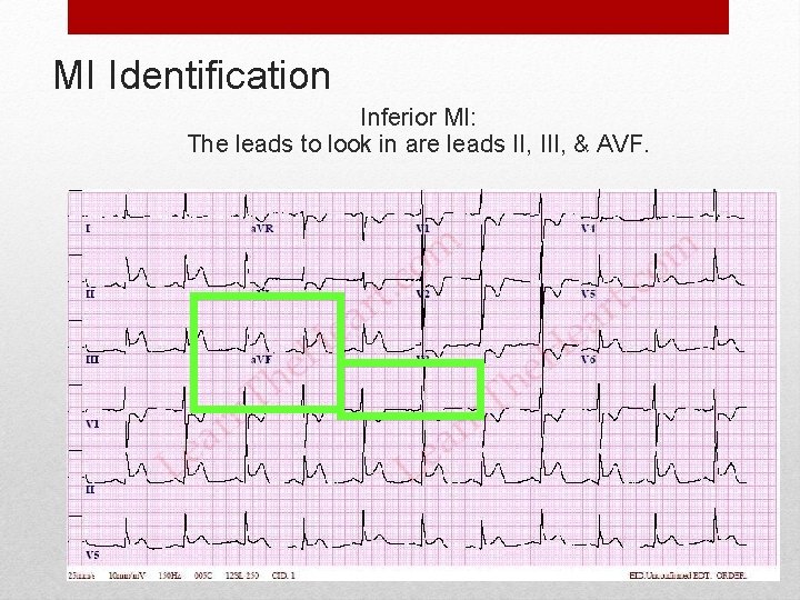 MI Identification Inferior MI: The leads to look in are leads II, III, &