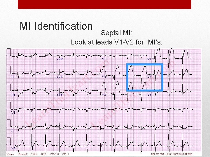 MI Identification Septal MI: Look at leads V 1 -V 2 for MI’s. 