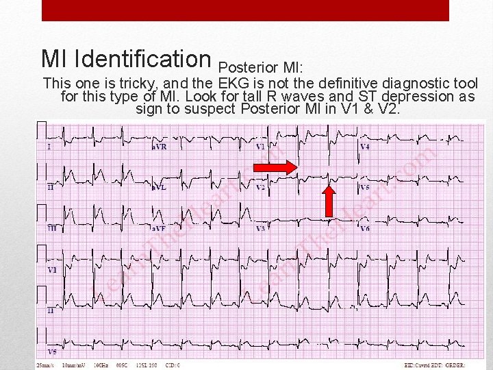 MI Identification Posterior MI: This one is tricky, and the EKG is not the