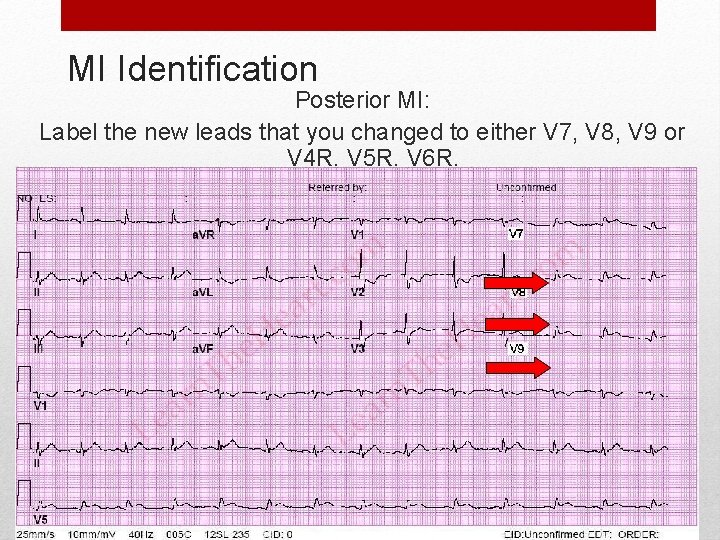 MI Identification Posterior MI: Label the new leads that you changed to either V