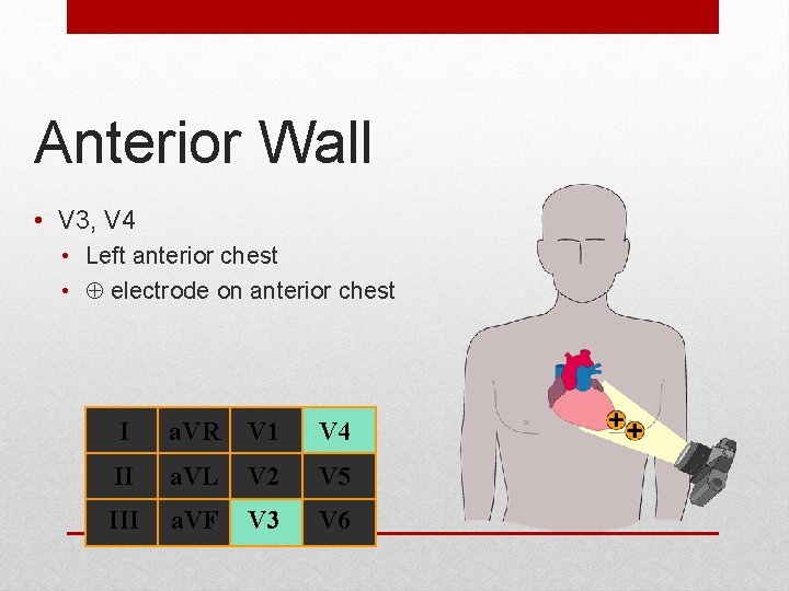Anterior Wall • V 3, V 4 • Left anterior chest • electrode on