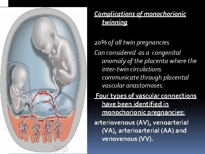 Complications of monochorionic twinning 20% of all twin pregnancies Can considered as a congenital Complications of monochorionic twinning 20% of all twin pregnancies Can considered as a congenital