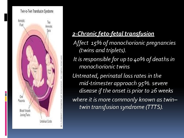 2 -Chronic feto-fetal transfusion Affect 15% of monochorionic pregnancies (twins and triplets). It is 2 -Chronic feto-fetal transfusion Affect 15% of monochorionic pregnancies (twins and triplets). It is