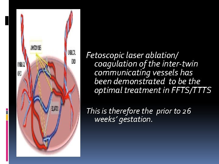 Fetoscopic laser ablation/ coagulation of the inter‐twin communicating vessels has been demonstrated to Fetoscopic laser ablation/ coagulation of the inter‐twin communicating vessels has been demonstrated to
