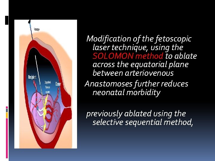Modification of the fetoscopic laser technique, using the SOLOMON method to ablate across Modification of the fetoscopic laser technique, using the SOLOMON method to ablate across