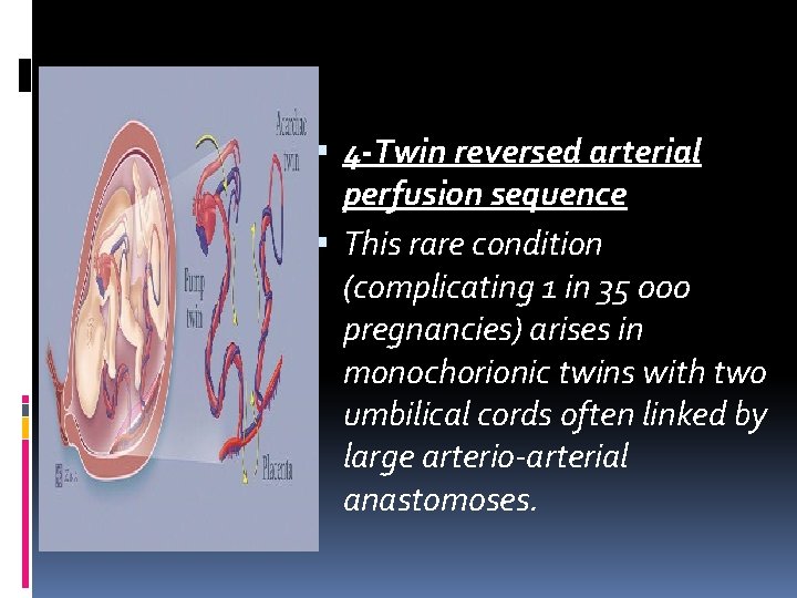 4 -Twin reversed arterial perfusion sequence This rare condition (complicating 1 in 35 4 -Twin reversed arterial perfusion sequence This rare condition (complicating 1 in 35