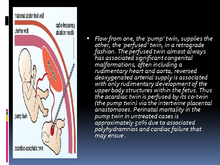 Flow from one, the ‘pump’ twin, supplies the other, the ‘perfused’ twin, in Flow from one, the ‘pump’ twin, supplies the other, the ‘perfused’ twin, in