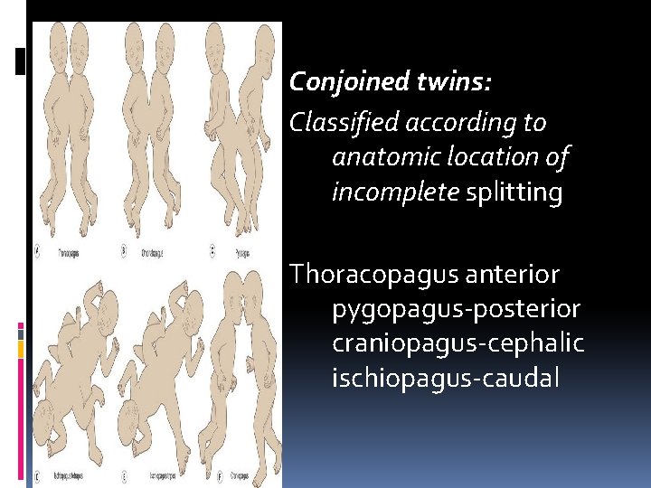 Conjoined twins: Classified according to anatomic location of incomplete splitting Thoracopagus anterior pygopagus-posterior craniopagus-cephalic Conjoined twins: Classified according to anatomic location of incomplete splitting Thoracopagus anterior pygopagus-posterior craniopagus-cephalic