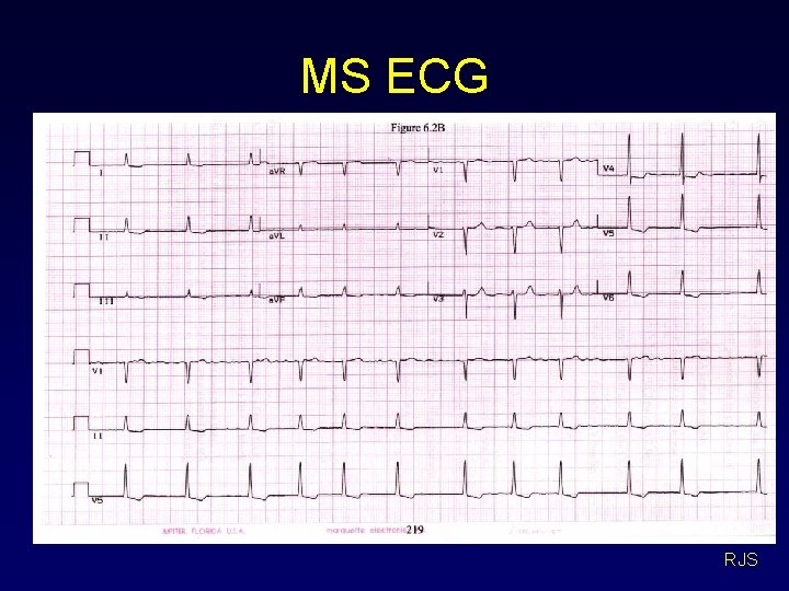 MS ECG RJS 