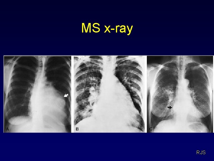 MS x-ray RJS 