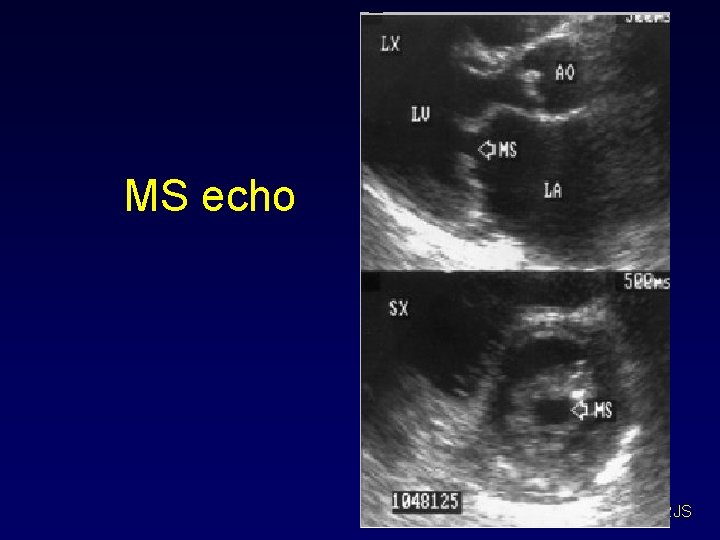 MS echo RJS 