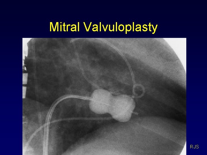 Mitral Valvuloplasty RJS 