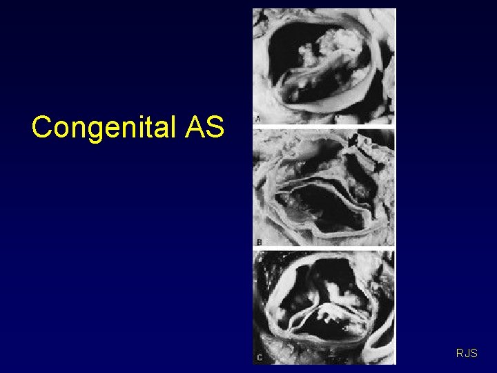 Congenital AS RJS 