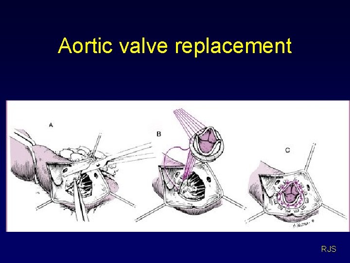 Aortic valve replacement RJS 