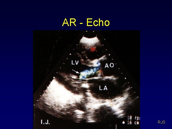 AR - Echo RJS 