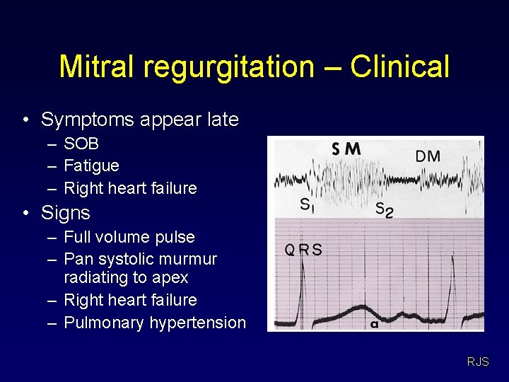 Mitral regurgitation – Clinical • Symptoms appear late – SOB – Fatigue – Right