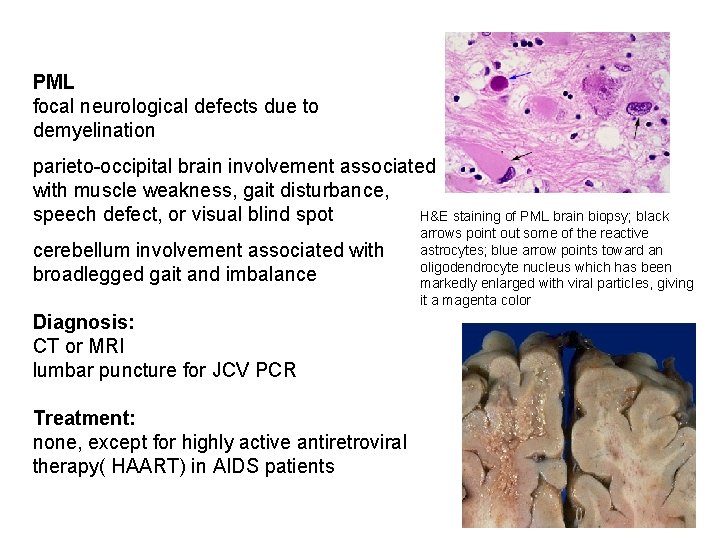 PML focal neurological defects due to demyelination parieto-occipital brain involvement associated with muscle weakness,