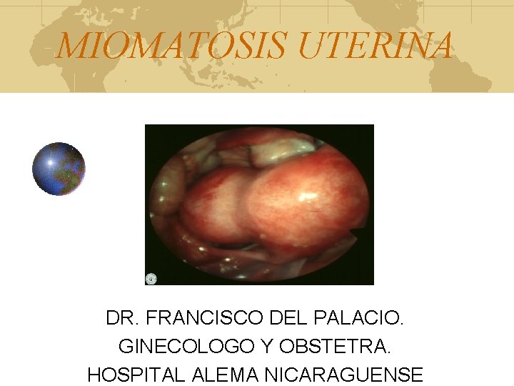 MIOMATOSIS UTERINA DR. FRANCISCO DEL PALACIO. GINECOLOGO Y OBSTETRA. HOSPITAL ALEMA NICARAGUENSE 