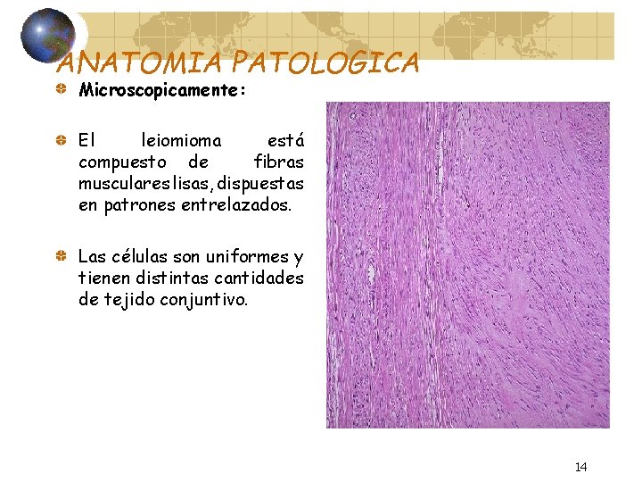 ANATOMIA PATOLOGICA Microscopicamente: El leiomioma está compuesto de fibras musculares lisas, dispuestas en patrones
