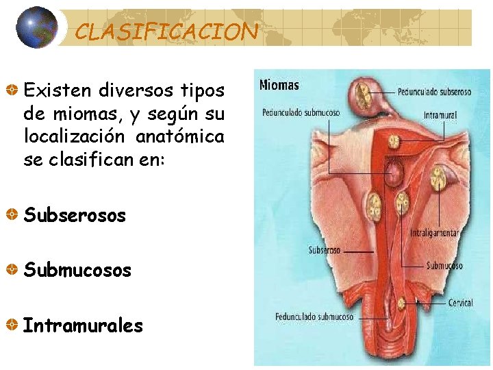 CLASIFICACION Existen diversos tipos de miomas, y según su localización anatómica se clasifican en: