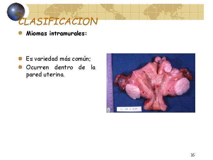 CLASIFICACION Miomas intramurales: Es variedad más común; Ocurren dentro de la pared uterina. 16
