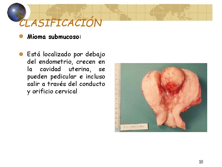 CLASIFICACIÓN Mioma submucoso: Está localizado por debajo del endometrio, crecen en la cavidad uterina,