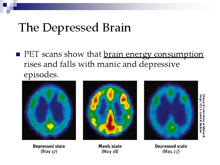 The Depressed Brain n PET scans show that brain energy consumption rises and falls