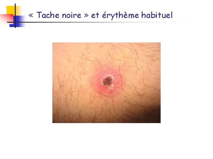  « Tache noire » et érythème habituel 