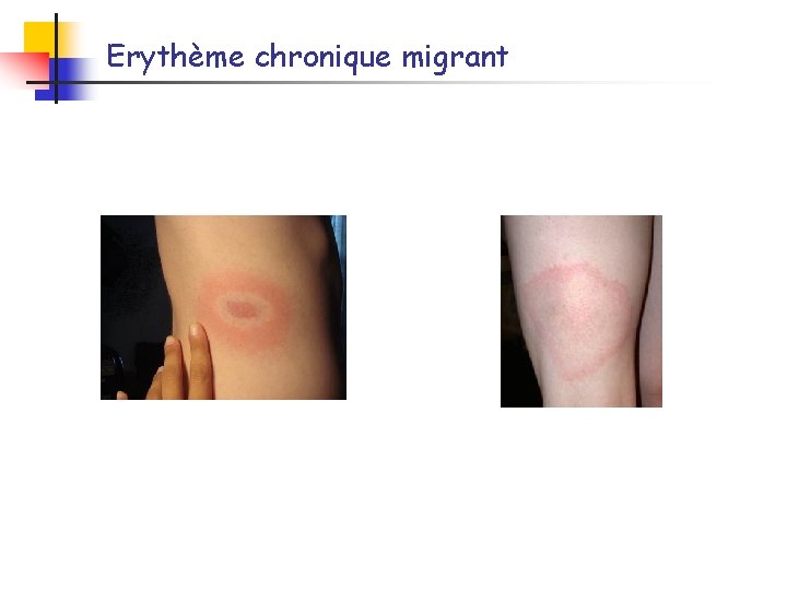 Erythème chronique migrant 