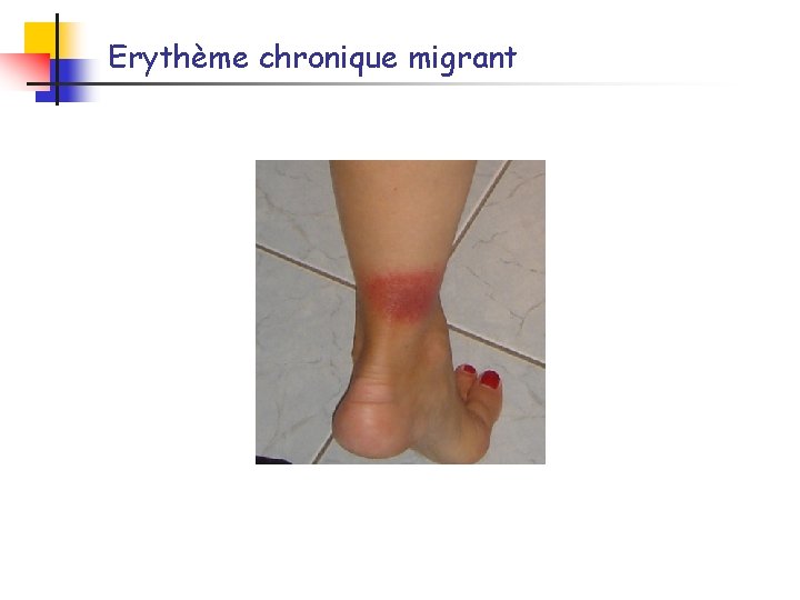Erythème chronique migrant 
