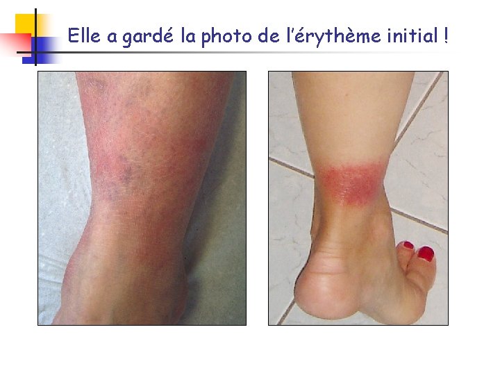 Elle a gardé la photo de l’érythème initial ! 