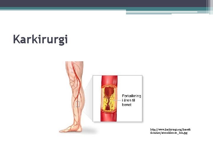 Karkirurgi http: //www. karkirurgi. org/karsyk dommer/aterosklerose_ben. jpg 