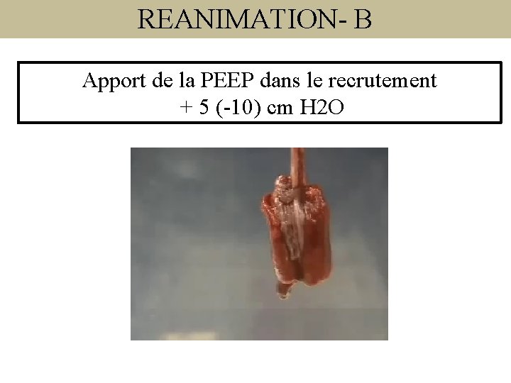 REANIMATION- B Apport de la PEEP dans le recrutement + 5 (-10) cm H