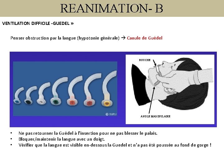 REANIMATION- B VENTILATION DIFFICILE -GUEDEL » Penser obstruction par la langue (hypotonie générale) Canule