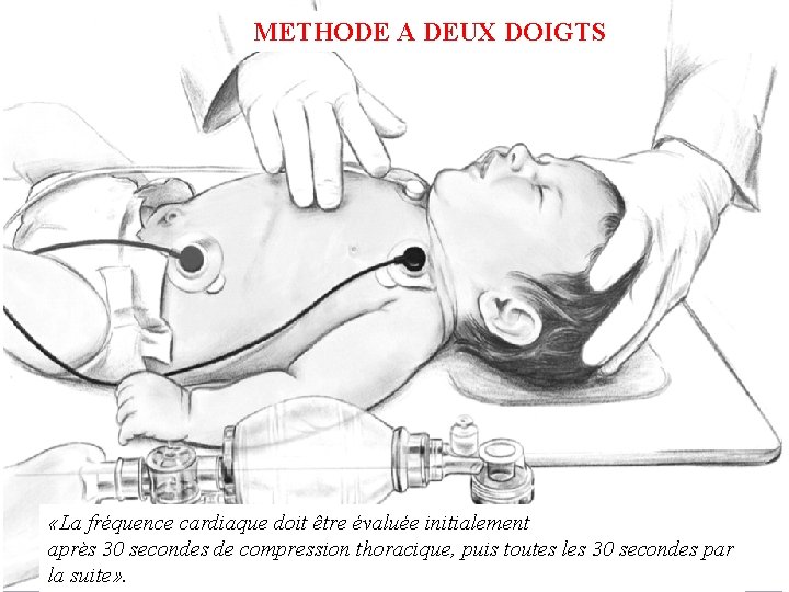 METHODE A DEUX DOIGTS «La fréquence cardiaque doit être évaluée initialement après 30 secondes